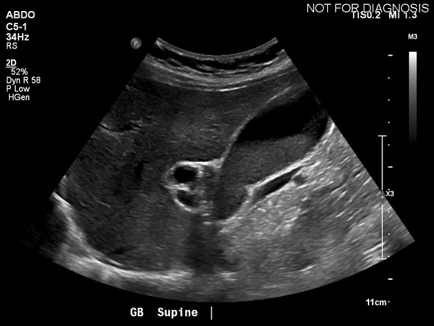 طين المرارة (Biliary Sludge): هل هي حالة خطيرة؟ وكيف تُعالج؟